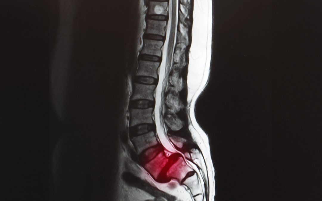 DJD and Spondylolisthesis